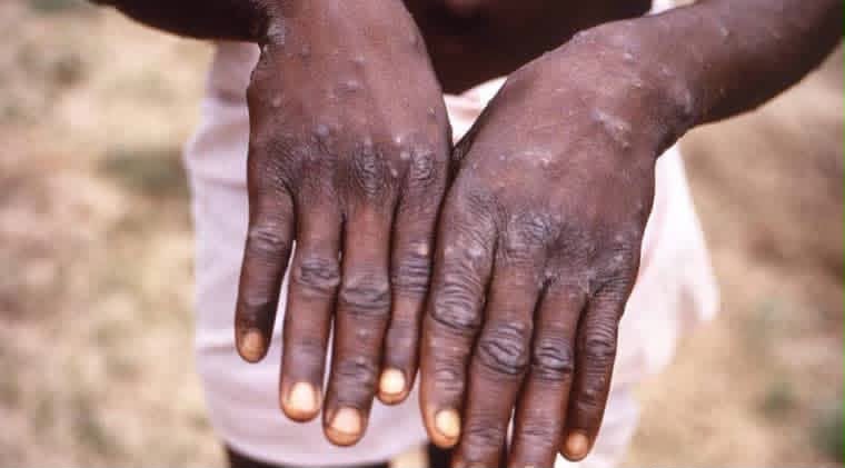 Santé: le Kasaï frappé par une nouvelle épidémie de Mpox