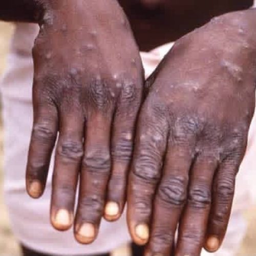 Santé: le Kasaï frappé par une nouvelle épidémie de Mpox
